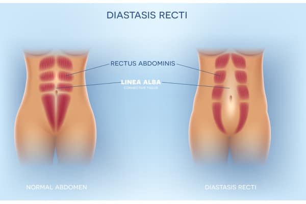 What Non-Surgical Options Are Available for Diastasis Recti Hinkley?