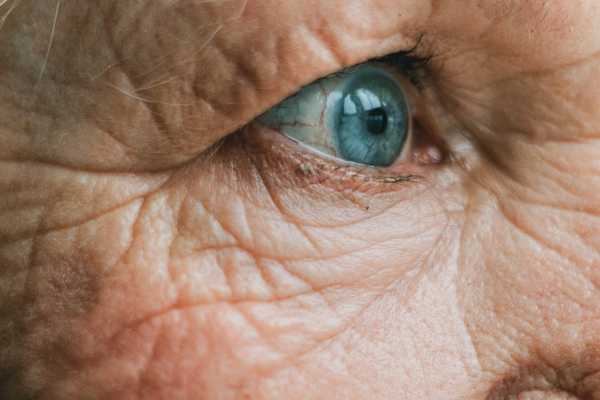 wrinkles
