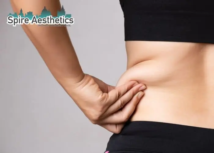 Image of woman pinching fat on their hips Hinkley. Fat Freezing treatment