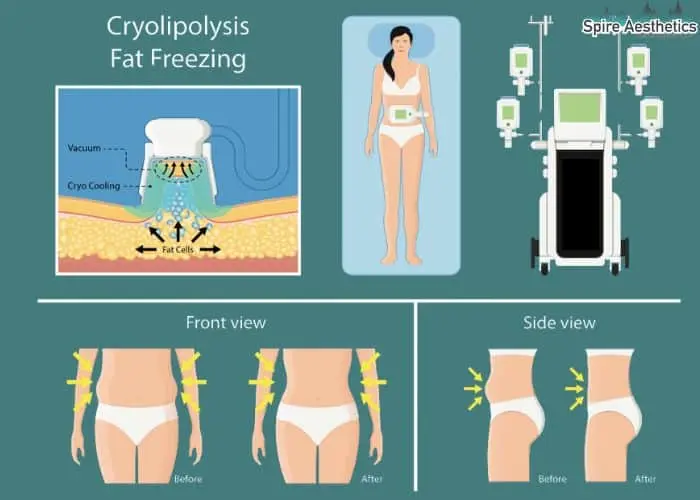 Fat freezing treatment Hinkley benefits for competitions to remove stubborn fat deposits.