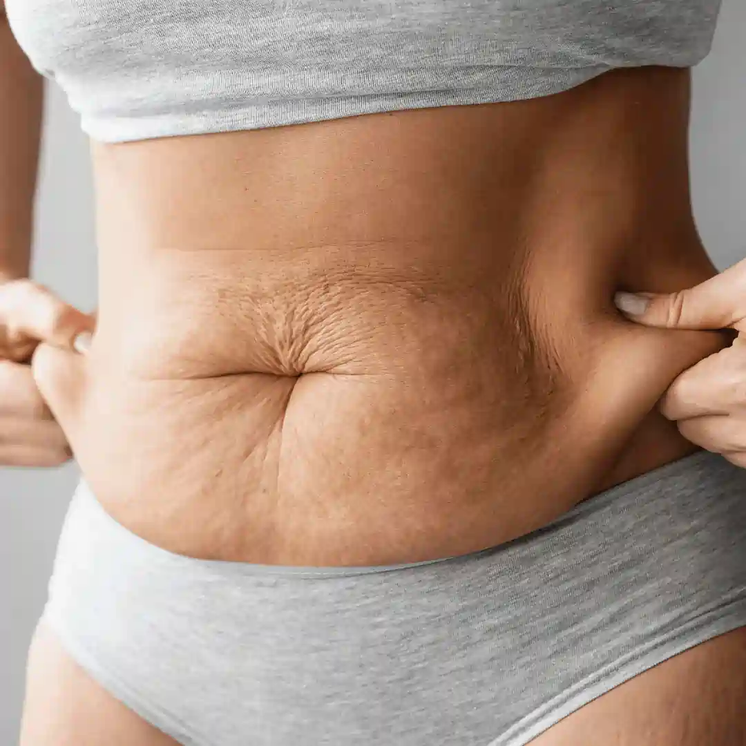 Is It Normal to Have Loose Skin After Pregnancy Hinkley?