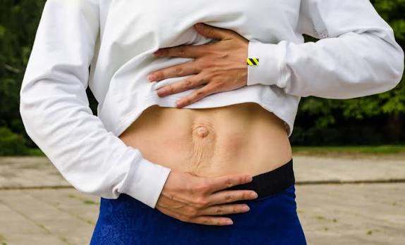 When Could Diastasis Recti Be the Missing Piece of the Puzzle Hinkley?