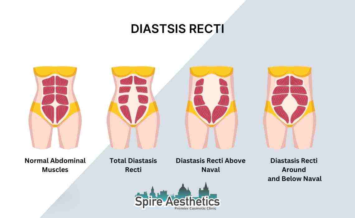Is Non-Surgical Diastasis Recti Treatment Right for You? Common Concerns Answered Hinkley